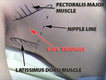 Safety triangle chest tube